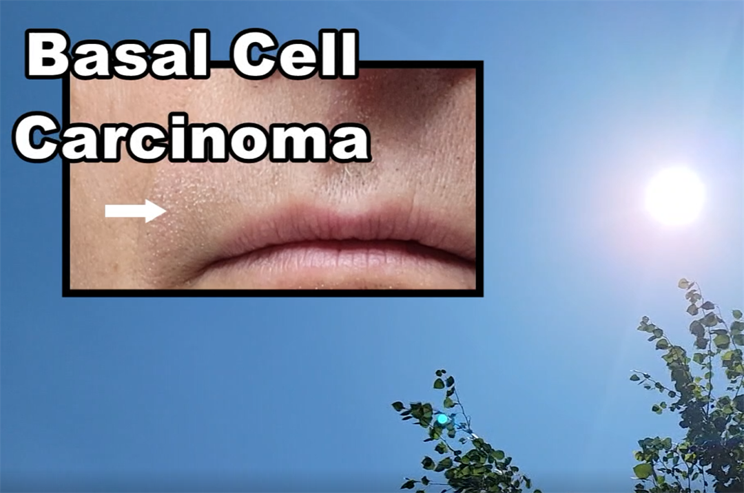 Skin cancer on rise in NE - Vimarsana News